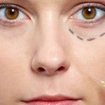 Botoks İle Sağlıklı Bir Şekilde İstediğiniz Görünüme Ulaşın