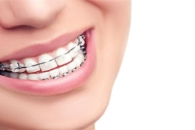 Diş Teli Fiyatları 2024 Yılı Düzenlemeleri