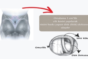 Acil Bel Fıtığı Ameliyatı Ne Zaman Gerekir?
