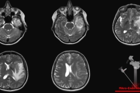 Beyin Tümörü Ameliyatı Hakkında Bilmeniz Gereken 7 Şey