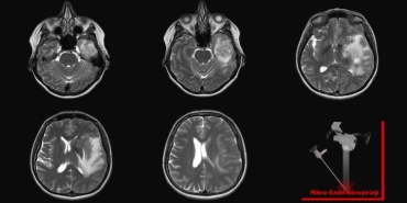 Beyin Tümörü Ameliyatı Hakkında Bilmeniz Gereken 7 Şey