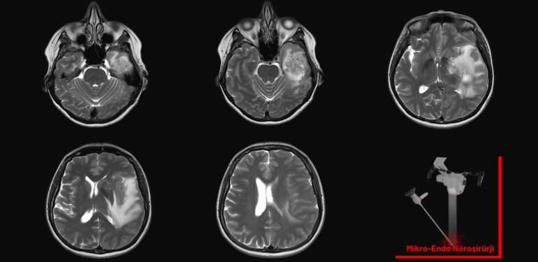 Beyin Tümörü Ameliyatı Hakkında Bilmeniz Gereken 7 Şey