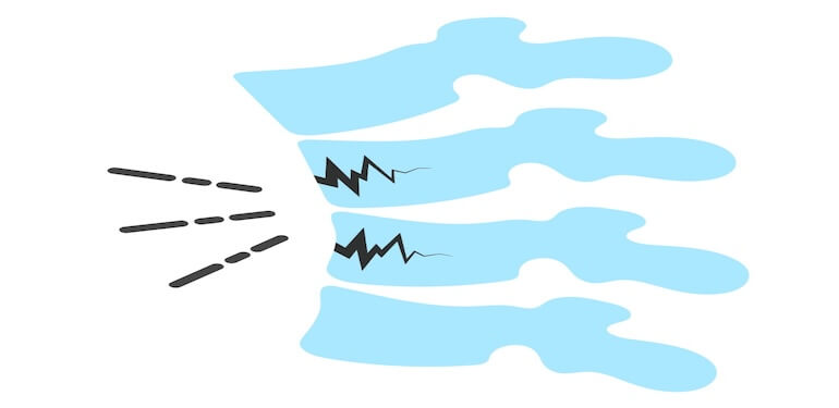 Omurga Kırığı ve Kifoplasti: Bilimsel Verilerle Modern Tedavi