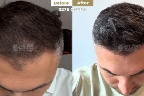 High-Precision haarimplantate at Este Surgery