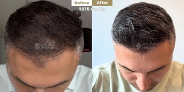 High-Precision haarimplantate at Este Surgery